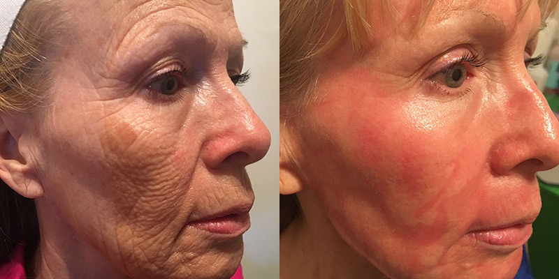 Before & After skin resurfacing on face