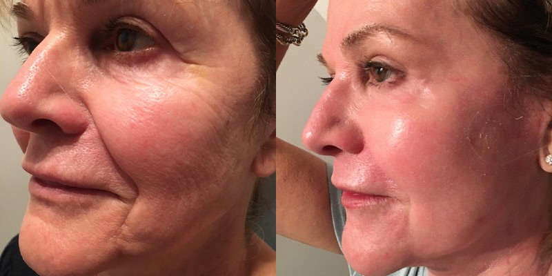 Before & After skin resurfacing on face