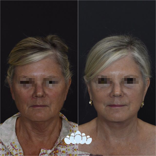 Beautiful deep plane facelift results of our patient 2 months postoperative.✨

#facelift #facialplastics #beforeandafter #naturalresults #dilworthfacialplastics #faceliftresults #faceliftbeforeandafter #facialplasticsurgeons #charlottenc