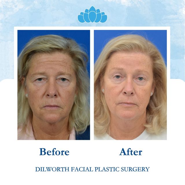 ✨Transformation Tuesday ✨

Ten months post-op from a brow lift and upper blepharoplasty, and our stunning patient looks more refreshed and rejuvenated than ever! Notice the subtle lift and brighter eyes that enhance her natural beauty. She’s thrilled with her results, and we couldn’t be happier for her. 

Ready to start your journey? Contact us today! 
📱 980-949-6544

#CharlotteUpperBleph #CharlotteBrowLift #BrowLiftCharlotte #UpperBlephCharlotte #CharlotteFacialSurgery #EyelidSurgeryCharlotte #RejuvenationCharlotte #FacialEnhancementCharlotte #CharlottePlasticSurgery