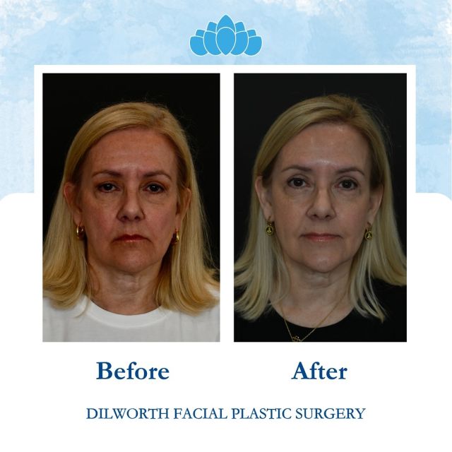 ✨Transformation Thursday ✨ 

Just one month post-op from an upper blepharoplasty, and our gorgeous patient is glowing! ✨ Sculpted, shaped, and supremely refreshed, her eyes are brighter and more vibrant, enhancing her natural beauty. The results speak for themselves, and she’s radiating confidence!

Ready to look this good? Contact us today! 💫
📱 980-949-6544

#CharlotteUpperBleph #CharlotteBrowLift #BrowLiftCharlotte #UpperBlephCharlotte 
#CharlotteFacialSurgery #EyelidSurgeryCharlotte #RejuvenationCharlotte #FacialEnhancementCharlotte #CharlottePlasticSurgery