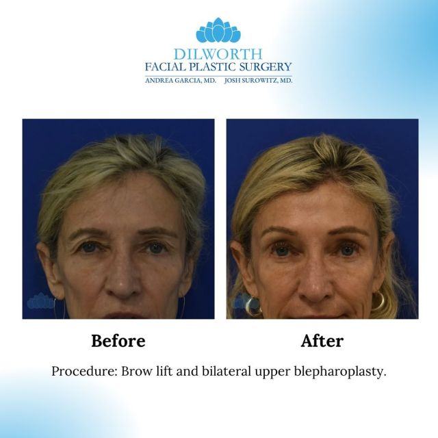 ✨ Feel Good Friday ✨ 
9 months post-op Brow Lift and Upper Blepharoplasty—what a transformation! This patient’s refreshed and natural results showcase the power of subtle enhancements that brighten the face and restore a youthful look. 

Ready to take the next step in your own transformation? Schedule your consultation today!

📱 980-949-6544

#CharlotteBrowLift #CharlotteUpperBleph #CharlotteFacialRejuvenation #BeforeAndAfter #DilworthFacialPlasticSurgery #CharlotteFacialPlasticSurgery #NaturalResults