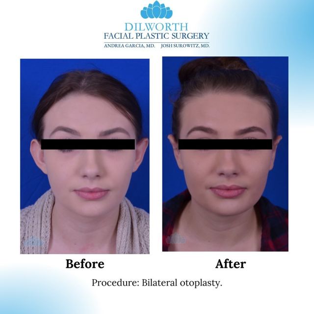 Feeling confident and radiant! ✨ Our lovely patient just completed her otoplasty journey, and the results speak for themselves. 💖👂 The smallest changes can make the biggest impact, and we’re so honored to be a part of her transformation.
 #otoplasty #charlotteplasticssurgery #beautyindetails 

Schedule your consultation today to begin your journey! 📞 980-949-6544