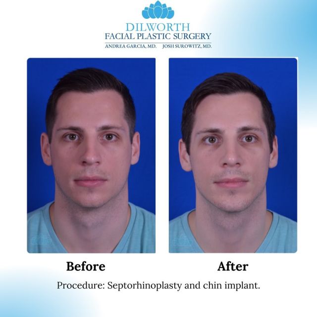 ✨Looking for a balanced facial profile? Check out this amazing profile transformation with a Septo-rhinoplasty and chin implant! ✨

🔹Whether you’re breathing better or enhancing your features, this powerful duo can bring your aesthetic goals to life.

🔹Ready to start your journey? DM us or call to schedule a consultation today!

☎️ 980-949-6544

#septorhinoplasty #chinimplant #facialharmonization  #charlottefacialplasticsurgery