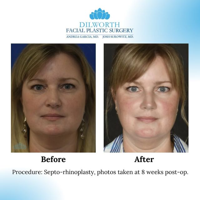 ✨ Septorhinoplasty Transformation! ✨

This procedure combines a rhinoplasty to enhance the shape of the nose with a septoplasty to correct a deviated septum—improving both the look and function of the nose. 💫

Whether you’re seeking a balanced, symmetrical nose or relief from breathing issues, a septorhinoplasty can be truly life-changing. Remember, every nose is unique, and your results should look natural and tailored to you. 🌟

Thinking about your own transformation? Reach out for a consultation to discuss your goals! 👃💖 980-949-6544

#Septorhinoplasty #BeforeAndAfter #NoseTransformation #BreatheBetter #Confidence