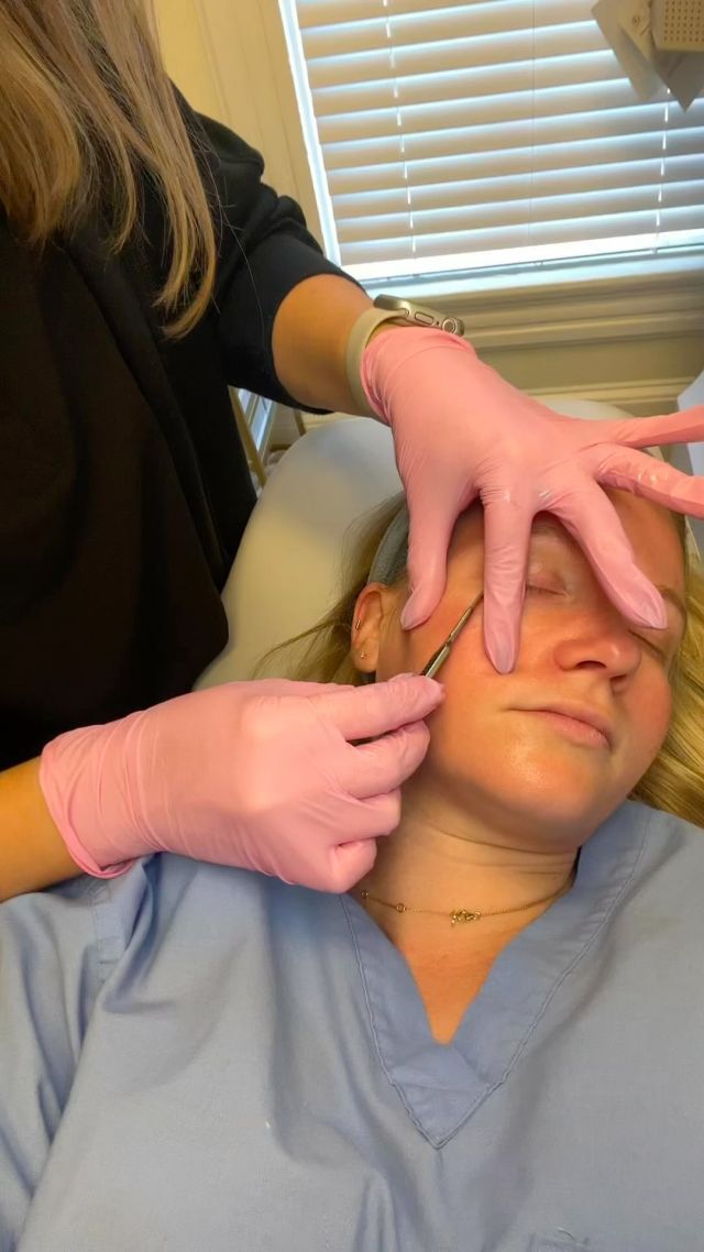 🌟Did you know we offer Dermaplaning?🌟

✨Dermaplaning is a non-invasive skincare treatment that removes dead skin cells and peach fuzz. 

✨This gentle exfoliation leaves your skin instantly smoother, brighter, and better prepared to absorb skincare products.

Ready for that radiant glow? Schedule your dermaplaning session with Allie today!
☎️980-949-6544

#dermaplaning #charlotteskincare #dilworthfacialplastics