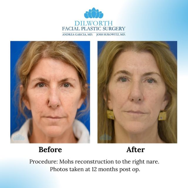 🌟Transformation Friday: MOHS Reconstruction or the Right Nare🌟

✨Rebuilding the right nostril after MOHS surgery requires precision to restore both function and a natural look. Using advanced techniques, we achieved seamless results that preserve the nostril’s shape and breathing.

✨If you need skin cancer reconstruction, we’re here to help you heal beautifully.

#MohsReconstruction #SkinCancerCare #FacialReconstruction