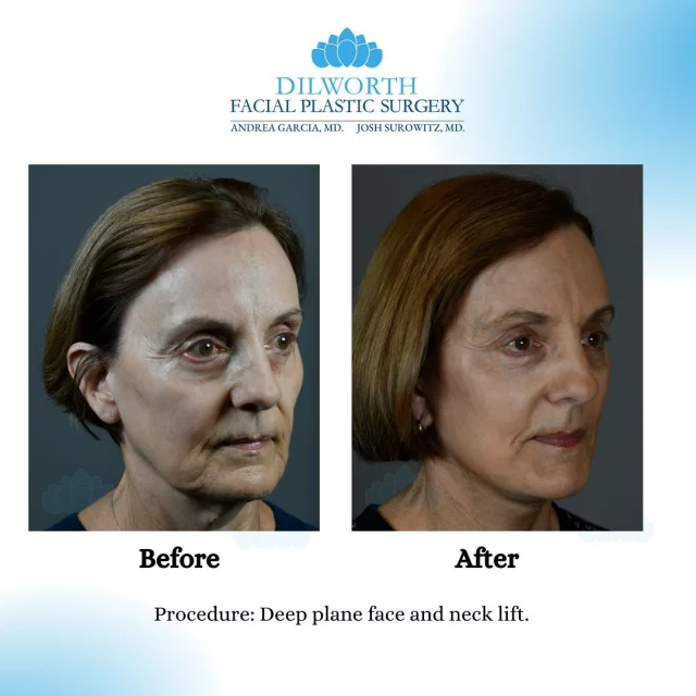 ✨ Facelift Transformation Alert! ✨

Witness the power of a beautifully executed facelift! These before and after photos show how a natural, refreshed look can take years off and bring back that youthful glow. 

Every detail matters—this transformation highlights smoother contours, lifted features, and a renewed confidence that shines through.

📩 DM to schedule a consultation today!

#FaceliftTransformation #FaceliftBeforeAndAfter #ConfidenceIsBeauty