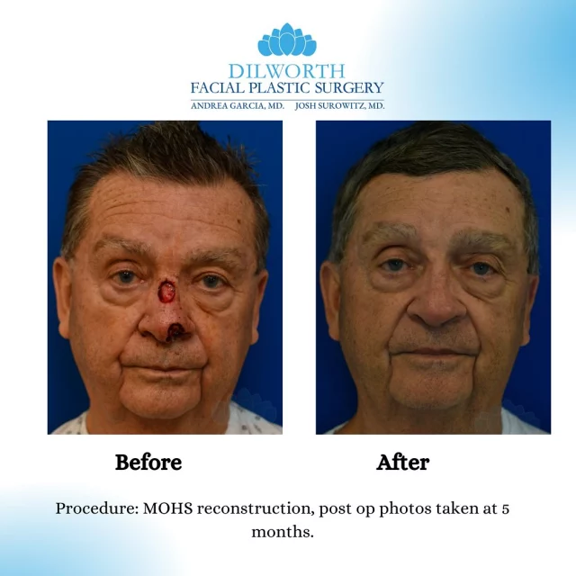 ✨ Mohs Closure Transformation ✨

Mohs surgery removes skin cancer with precision, but the closure is where artistry meets expertise. Our skilled surgeons ensure the best cosmetic outcome by carefully aligning the skin for minimal scarring and a natural look.

Swipe to see the transformation—this is why surgical technique matters! Trust experience, precision, and attention to detail for the best results.

If you have a Mohs surgery coming up and want the best cosmetic outcome, let’s chat about it! 

#MohsClosure #SkinCancer #ScarMinimization #PlasticSurgery #HealthySkin #charlotteplasticsurgeons