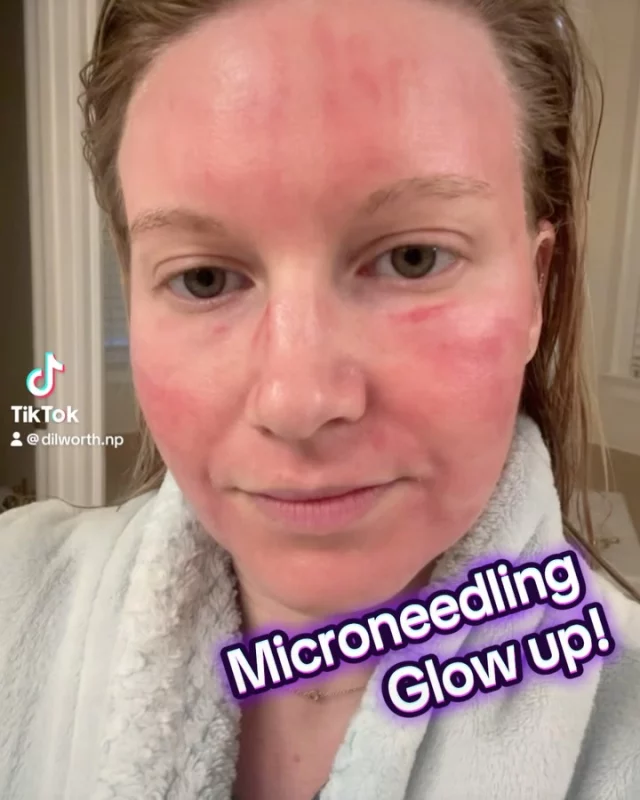 ✨ Microneedling Magic! ✨
Looking for a way to rejuvenate your skin and achieve a smoother, more radiant complexion? Microneedling might be the answer!

✅ Boosts collagen production
✅ Reduces fine lines and wrinkles
✅ Improves skin texture and tone
✅ Minimizes acne scars and pores

Swipe to see real progress from day 1 to 5 ➡️

Ready to transform your skin? Book your consultation today!

#Microneedling #SkinRejuvenation #GlowUp #CharlotteAesthetics #SkinCareJourney #CollagenBoost #BeautyTransformation