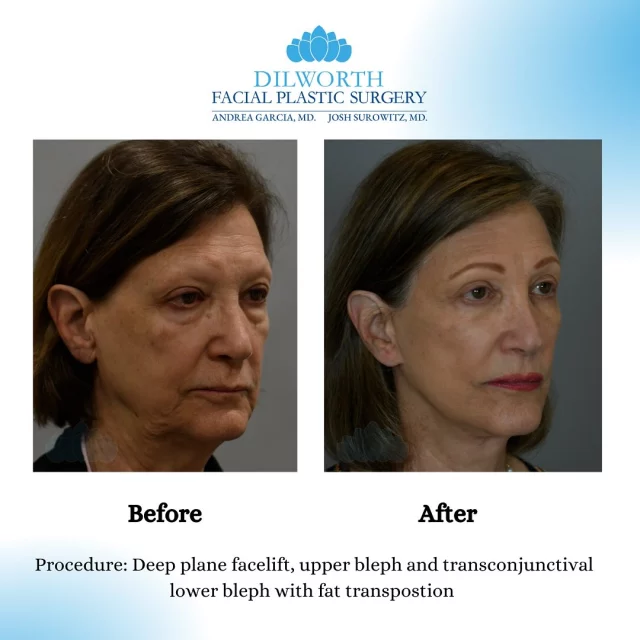 ✨ Transformation Friday! ✨

This beautiful patient underwent a deep plane facelift, upper blepharoplasty, and transconjunctival lower blepharoplasty with fat transposition to restore a youthful, refreshed look. The results? A natural yet dramatic rejuvenation!

At Dilworth Facial Plastic Surgery, our goal is to enhance your beauty while maintaining a natural appearance. Ready to take the next step? Schedule a consultation today!

#Facelift #Blepharoplasty #FacialRejuvenation #CharlottePlasticSurgery #NaturalResults